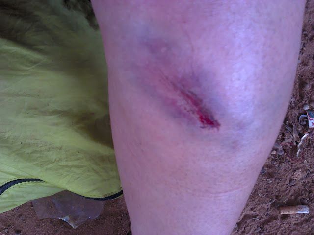 Mi pierna herida después de la caída 